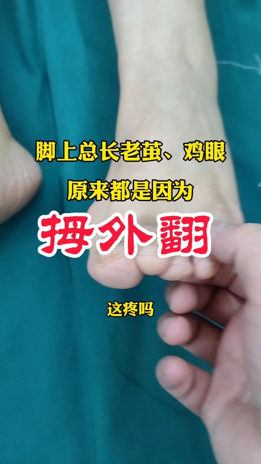 脚上总长老茧、鸡眼,原来都是因为拇外翻 #拇外翻 #大脚骨 #运城拇外翻