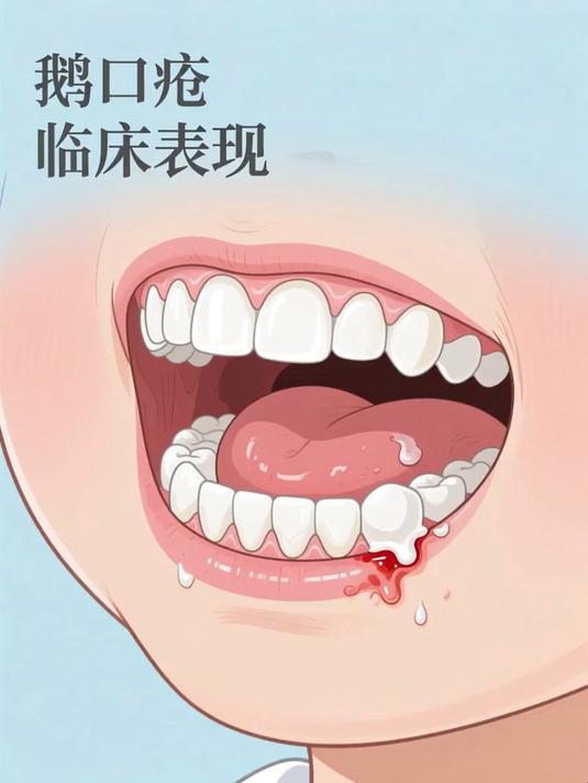 鹅口疮临床表现