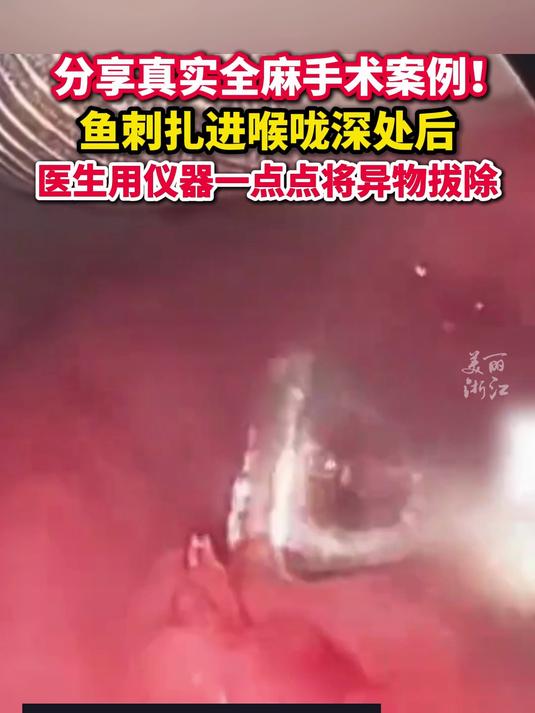 触目惊心!第一视角感受医生如何拔鱼刺