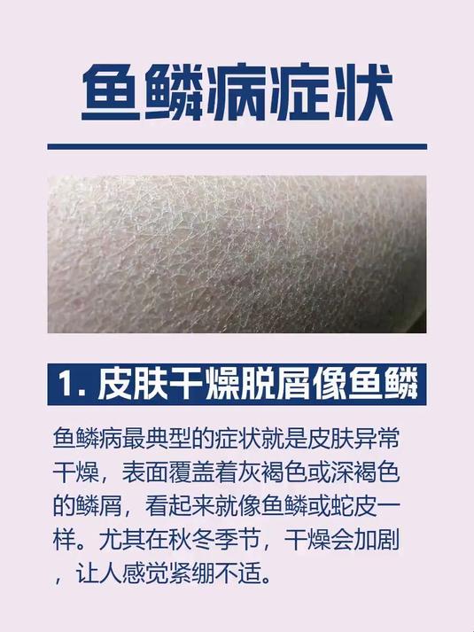 鱼鳞病症状