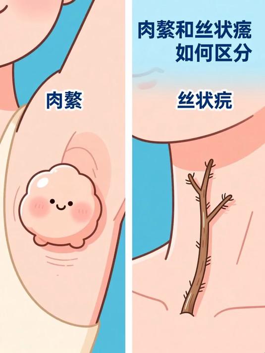 肉赘和丝状疣如何区分 #健康扬帆季#