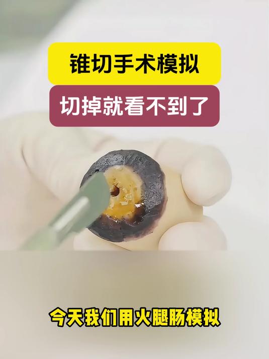 冷刀锥切 妇科 医学科普 手术日常