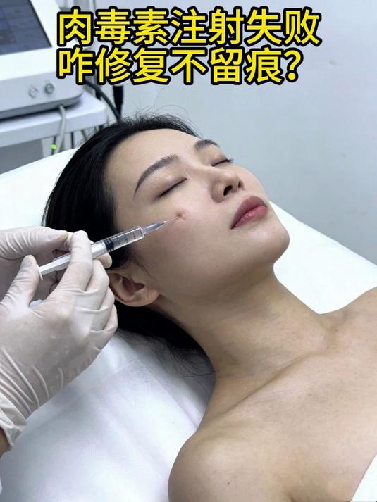 #健康扬帆季#肉毒素注射失败咋修复不留痕？