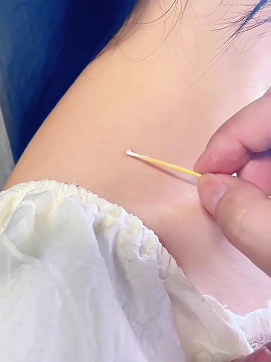 一点决绝!清点肌肤小肉刺