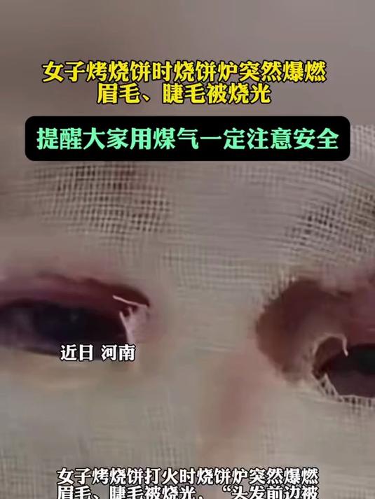 女子烤烧饼时烧饼炉突然爆燃:眉毛、睫毛被烧光