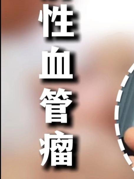 男孩眼角肉芽肿性血管瘤,家长跑遍多家医院,都说治不了!#血管瘤# #动脉瘤# #血管畸形#