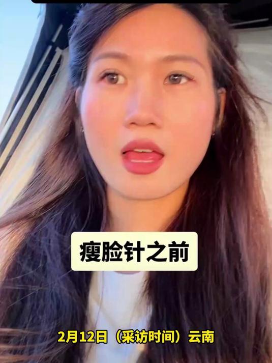 女子嫌咬肌大 去打瘦脸针,结果脸严重凹陷 变大小脸!
