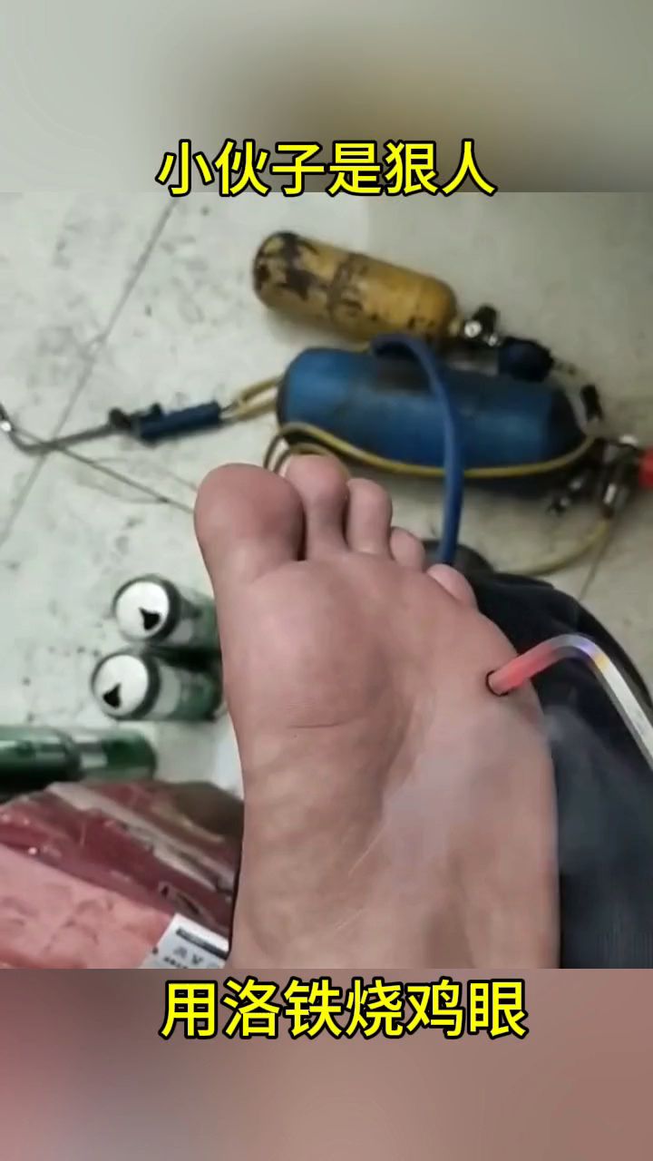 小伙子是狠人,用烙铁烧鸡眼