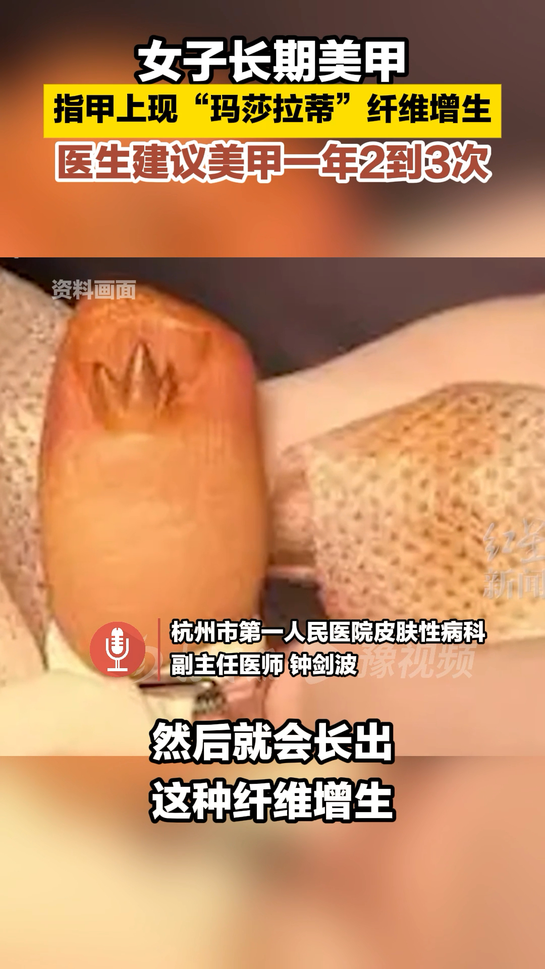 女子长期美甲 指甲上现“玛莎拉蒂”纤维增生 建议美甲一年2到3次