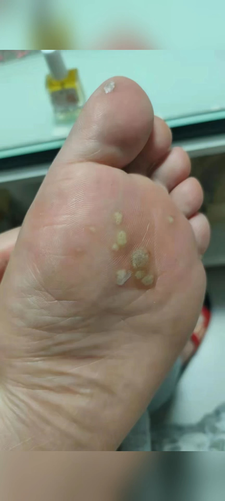 足底长了跖疣那又怎么样