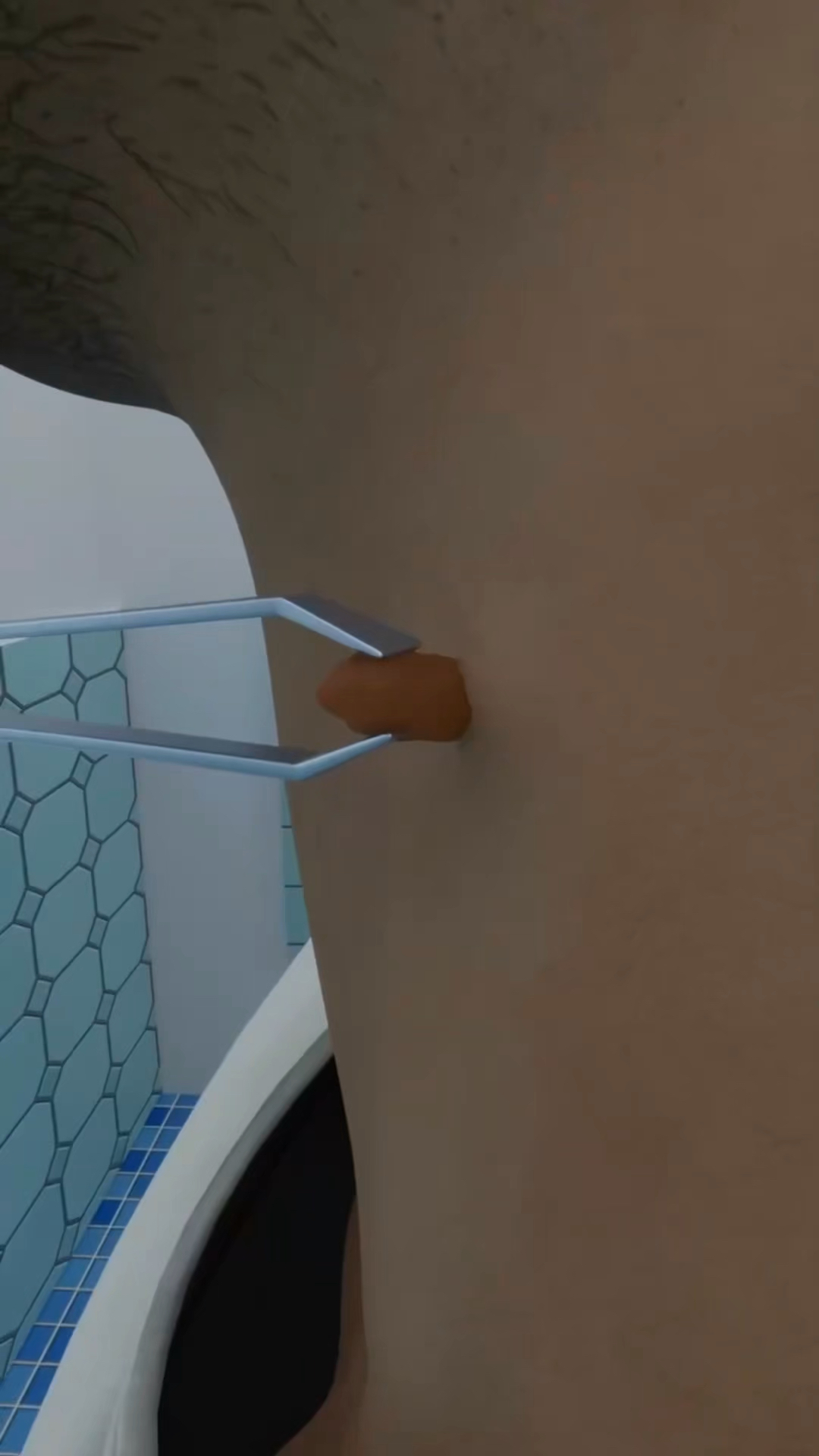 不要随便去除皮赘