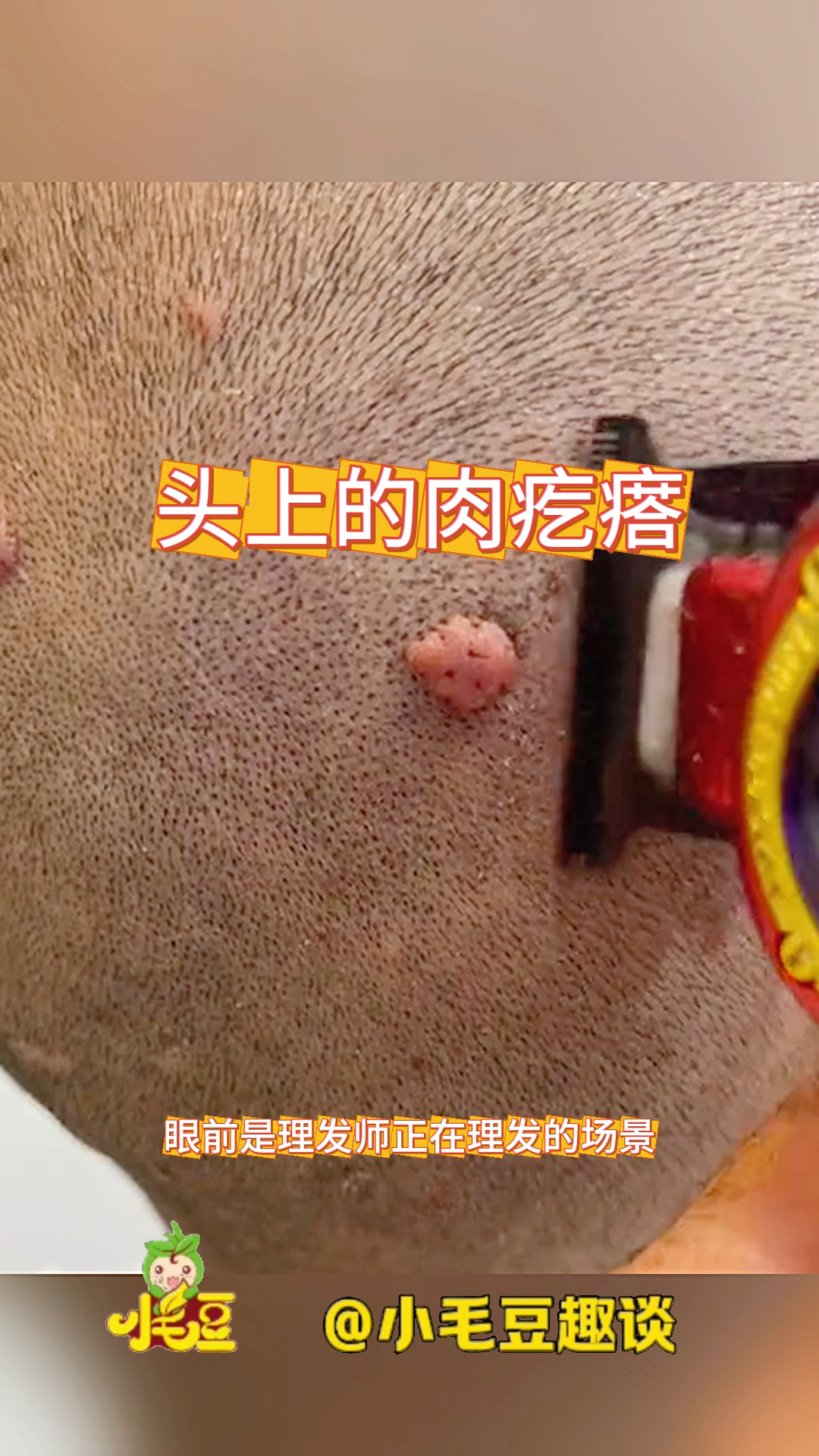 头上的肉疙瘩,险些给他剪下去