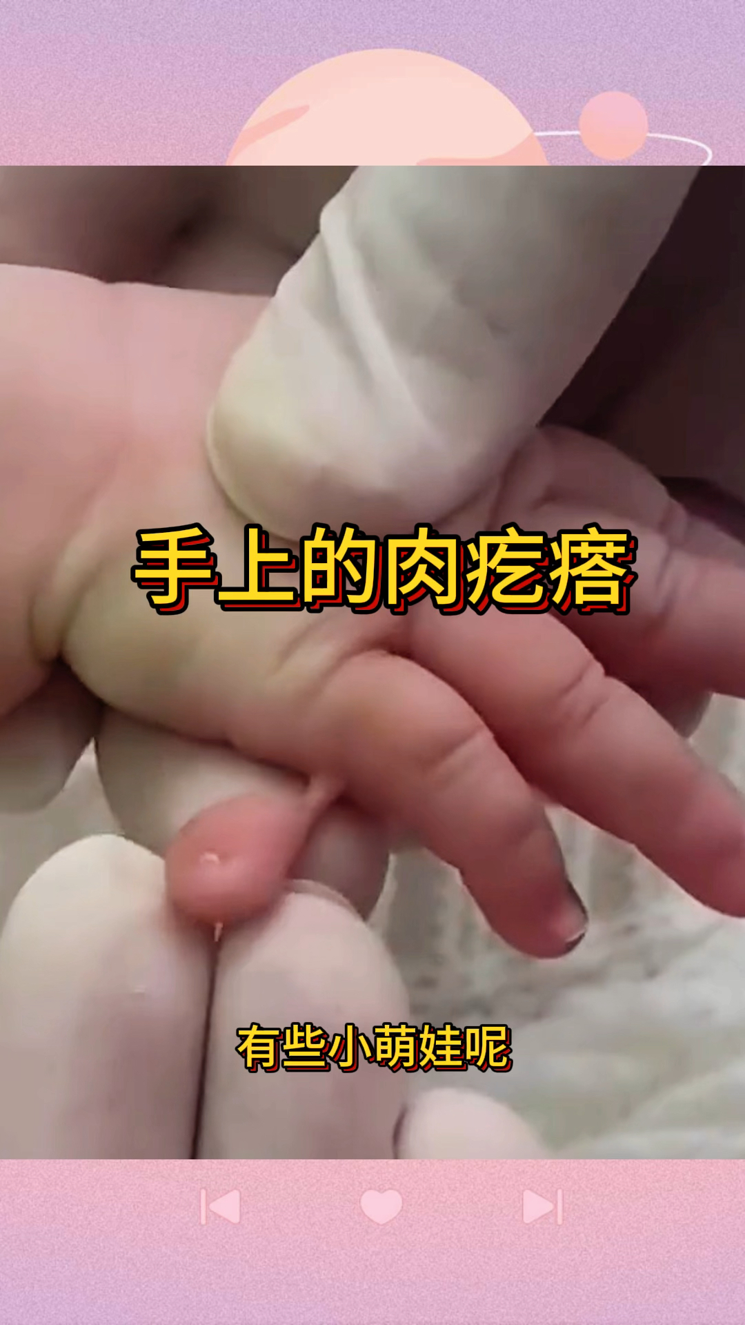 手上的肉疙瘩,到底该怎么办呢?