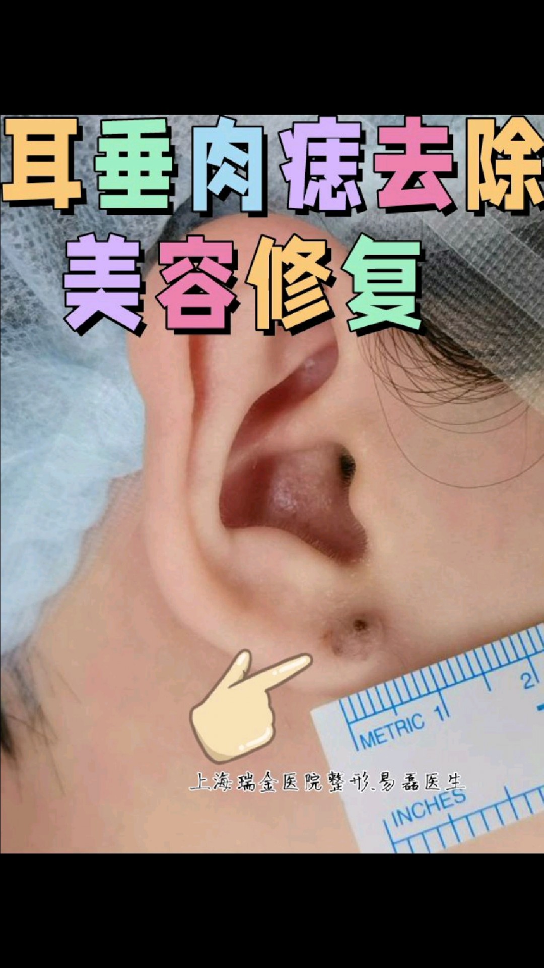 耳垂切痣,美容修复