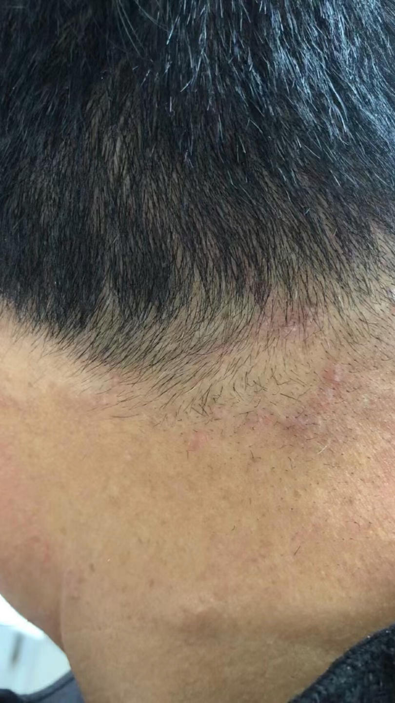 项部环状肉芽肿治疗7天前后对比图