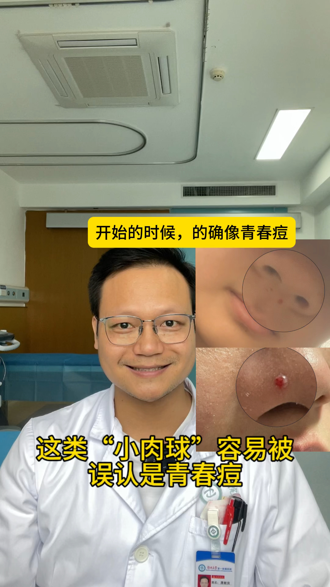 青春痘?还是肉芽肿?