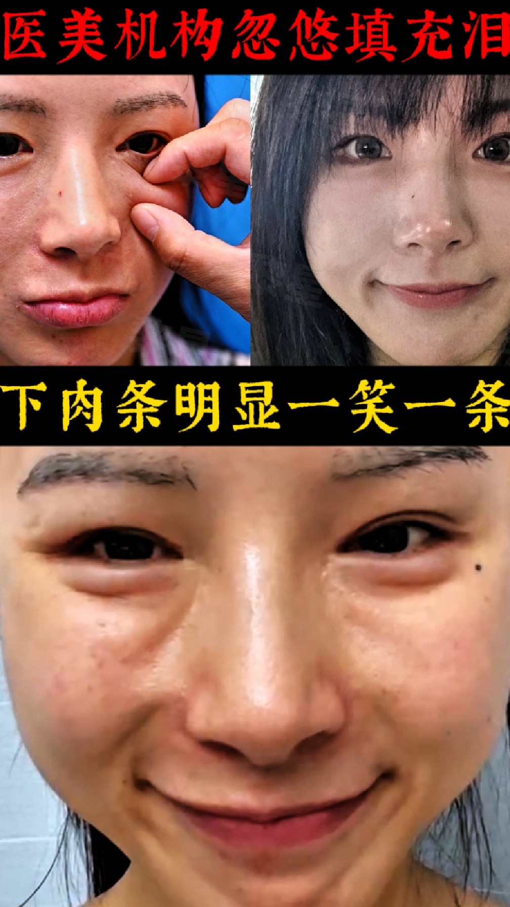 医美机构套路深,被忽悠填充泪沟,眼下肉条明显,泪沟凸起一条棱