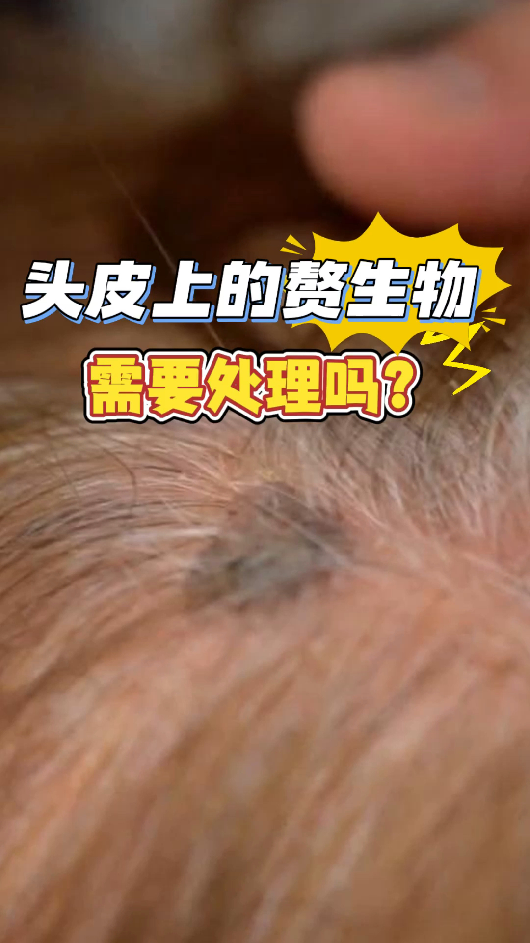 头皮赘生物需要处理吗?