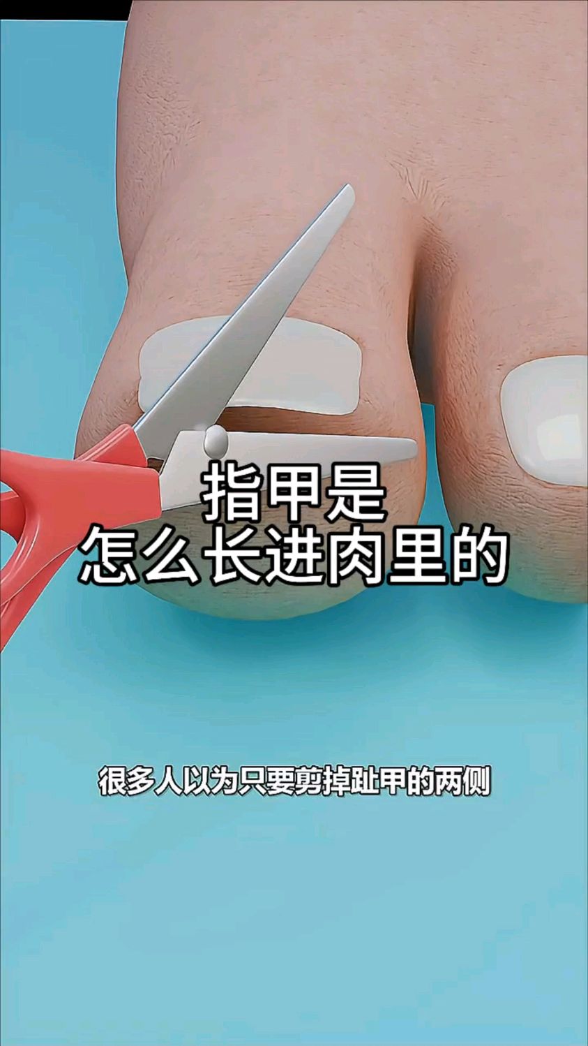 指甲是怎么长进肉里的