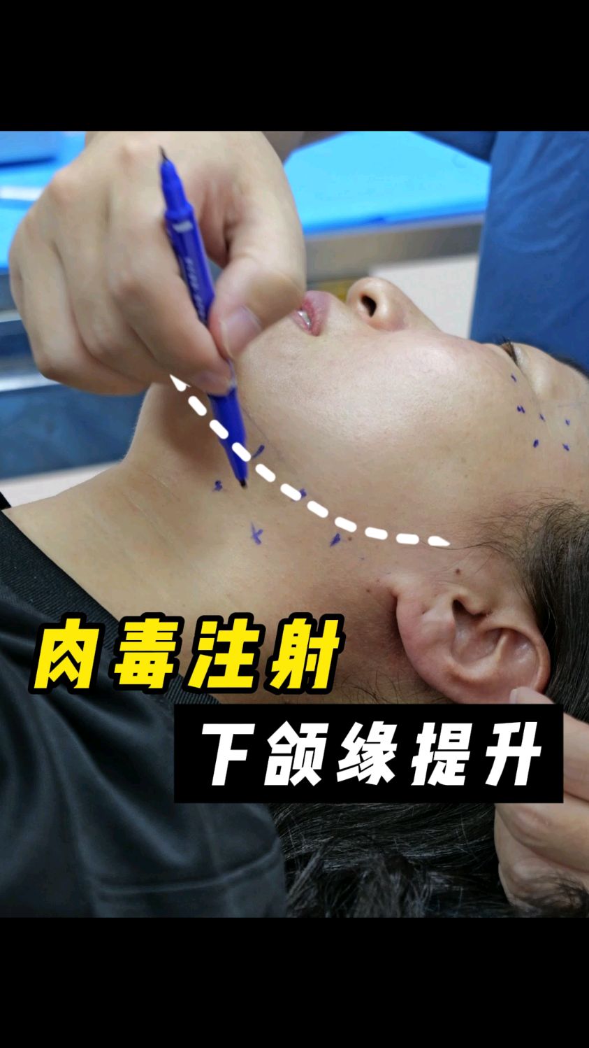 肉毒注射下颌缘提升