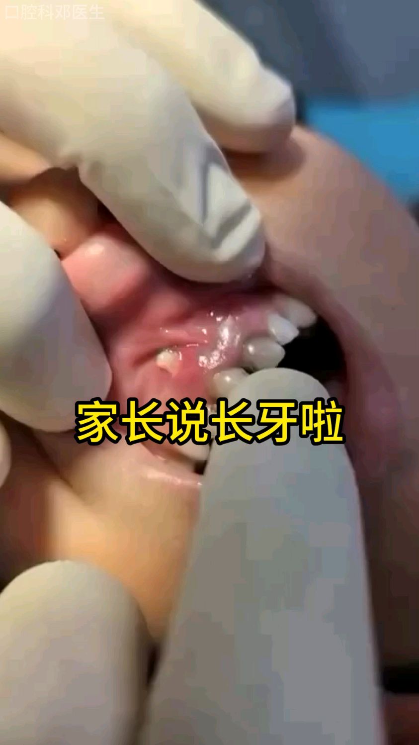 这个不是长新牙,而是牙根穿透了牙肉