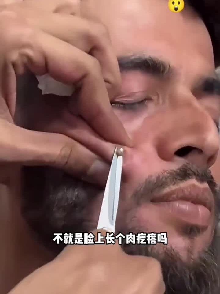 用剪刀剪肉疙瘩,看着都疼