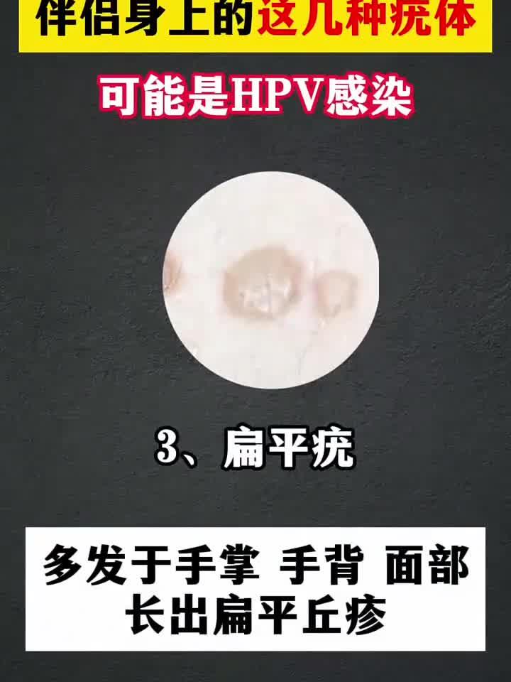 伴侣身上的几种疣体 可能是hpv感染