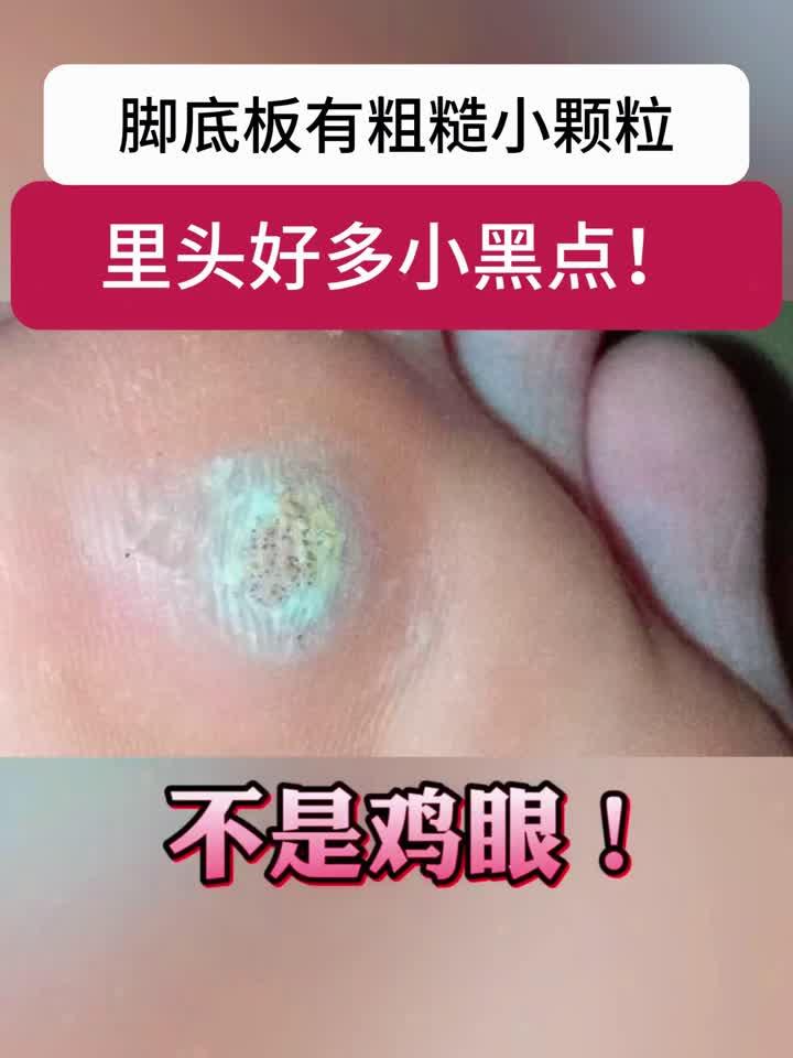 脚底板长小疙瘩,里面有很多小黑点,可别当鸡眼治!这是跖疣
