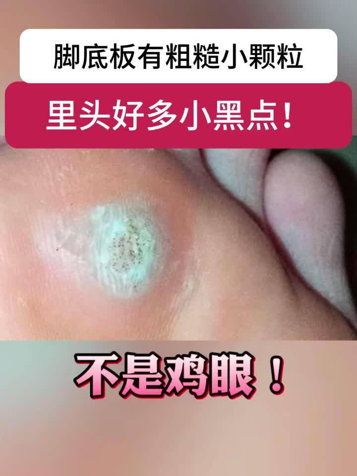 脚底板长小疙瘩,里面有很多小黑点,可别当鸡眼治!这是跖疣