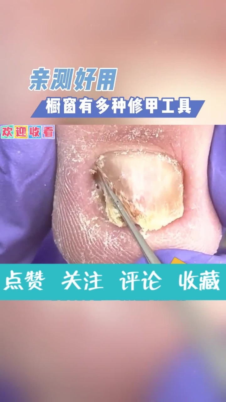 增厚变硬的指甲，修剪后留下两个深深肉坑