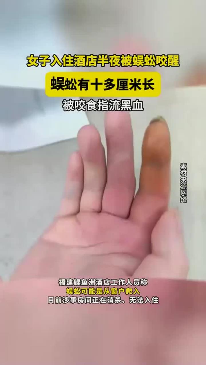 女子入住酒店半夜被蜈蚣咬醒