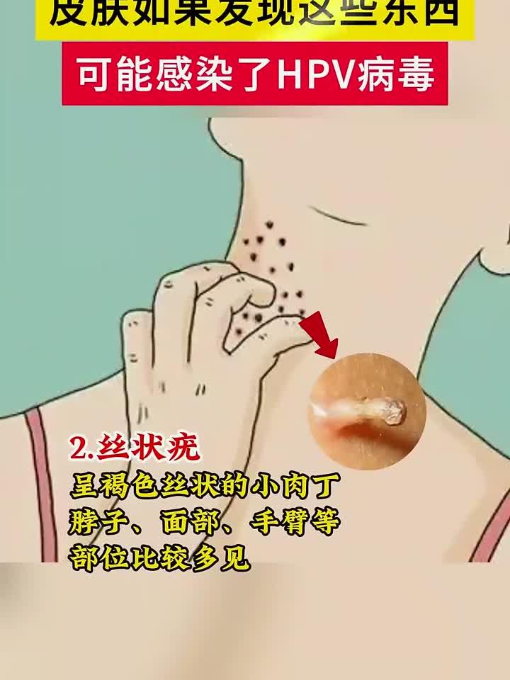 皮肤如果发现了这些东西可能感染了HPV病毒