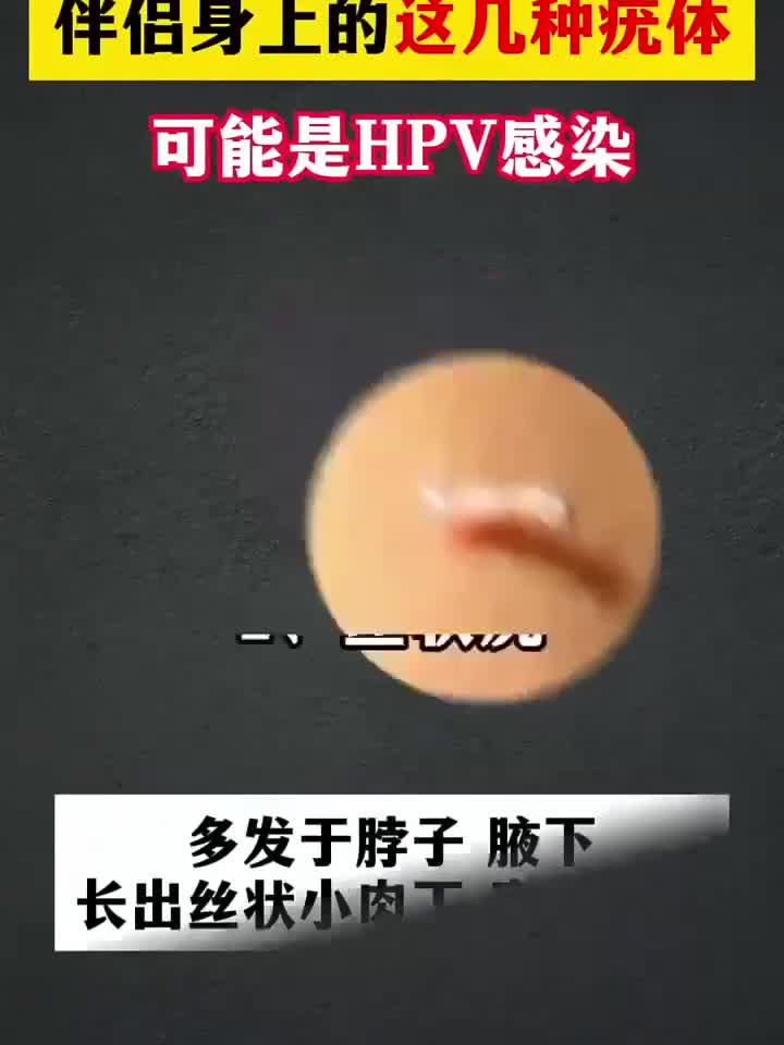 伴侣皮肤长疣需警惕,可能是HPV感染信号