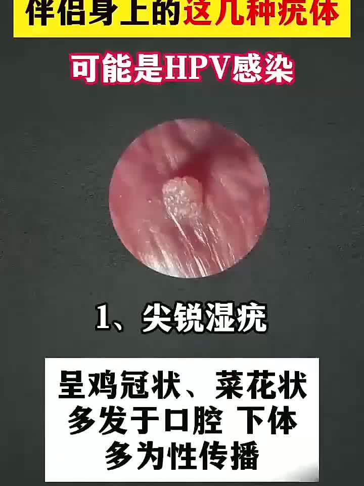 伴侣身上出现这些疣体,当心是HPV感染信号!