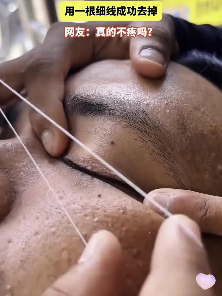 男子眼睛上长了一个肉粒，用一根细线成功去掉，网友：真的不疼吗