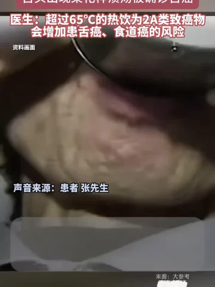 男子20年热饮养生,舌面惊现菜花状肿瘤确诊舌癌