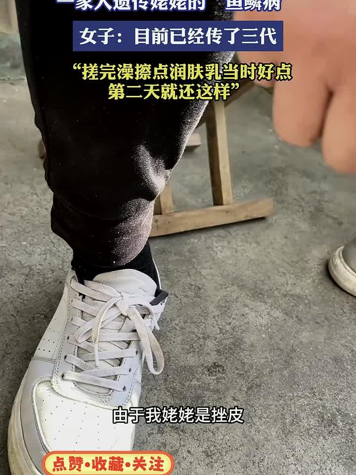 三代人遗传“鱼鳞病”，女子无奈：搓澡润肤仅能短暂缓解