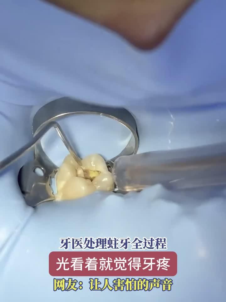 牙医治疗蛀牙全流程实拍,光看画面牙齿已经开始隐隐作痛