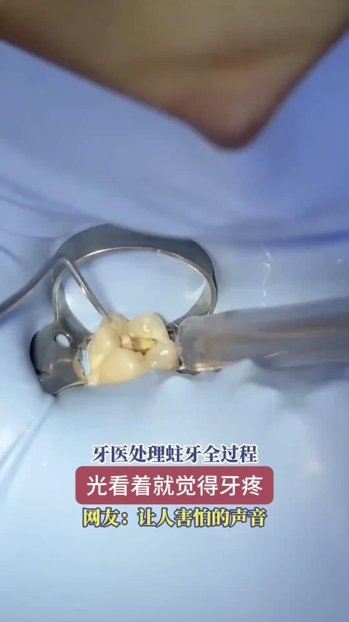 健养分享:牙医处理蛀牙全过程,光是看着就感觉牙疼