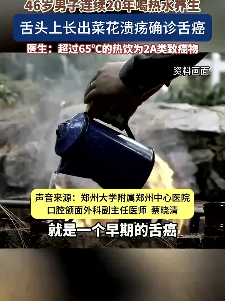 健康那些事：46岁男子坚持喝热水20年养生竟患舌癌舌头长出菜花状