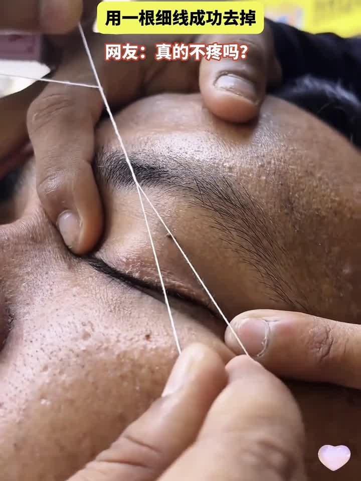 男子眼睛上长了一个肉粒,用一根细线成功去掉,网友:真的不疼吗