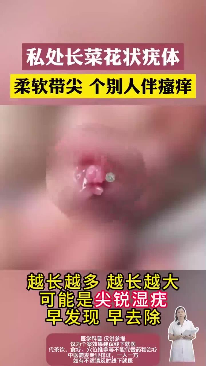 私处长菜花状疣体