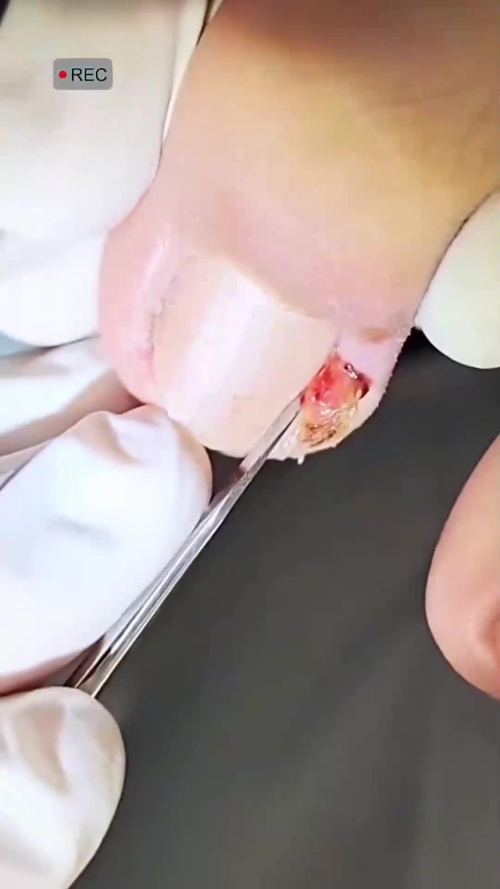 用鱼钩处理嵌甲,沉浸式修脚超解压