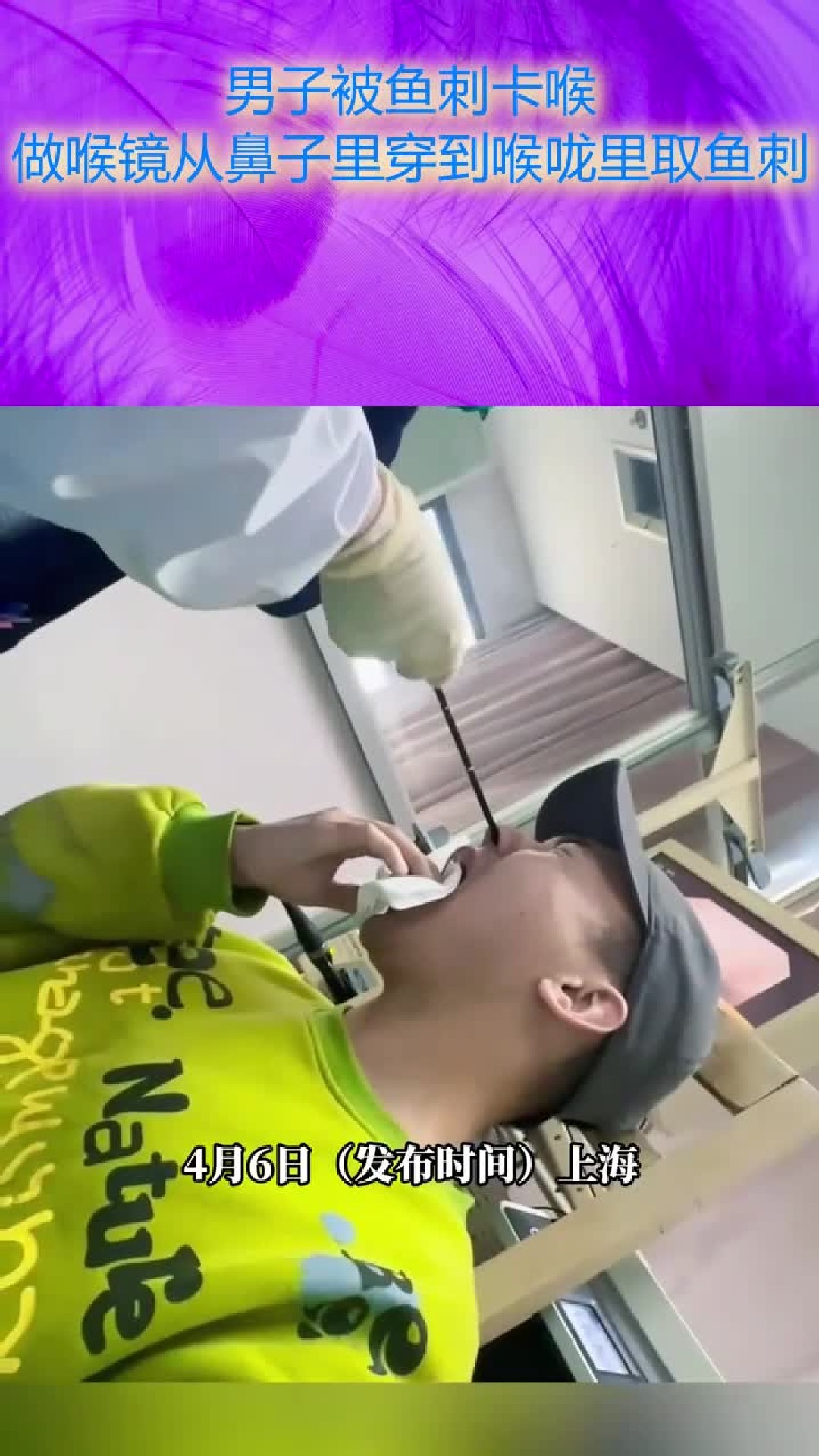 男子被鱼刺卡喉,做喉镜从鼻子里穿到喉咙里取鱼刺