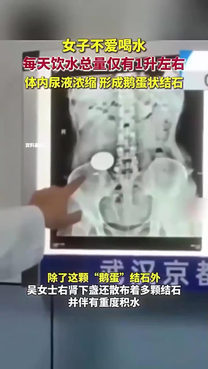 女子不爱喝水,每天饮水总量仅有1升左右,体内尿液浓缩,形成鹅