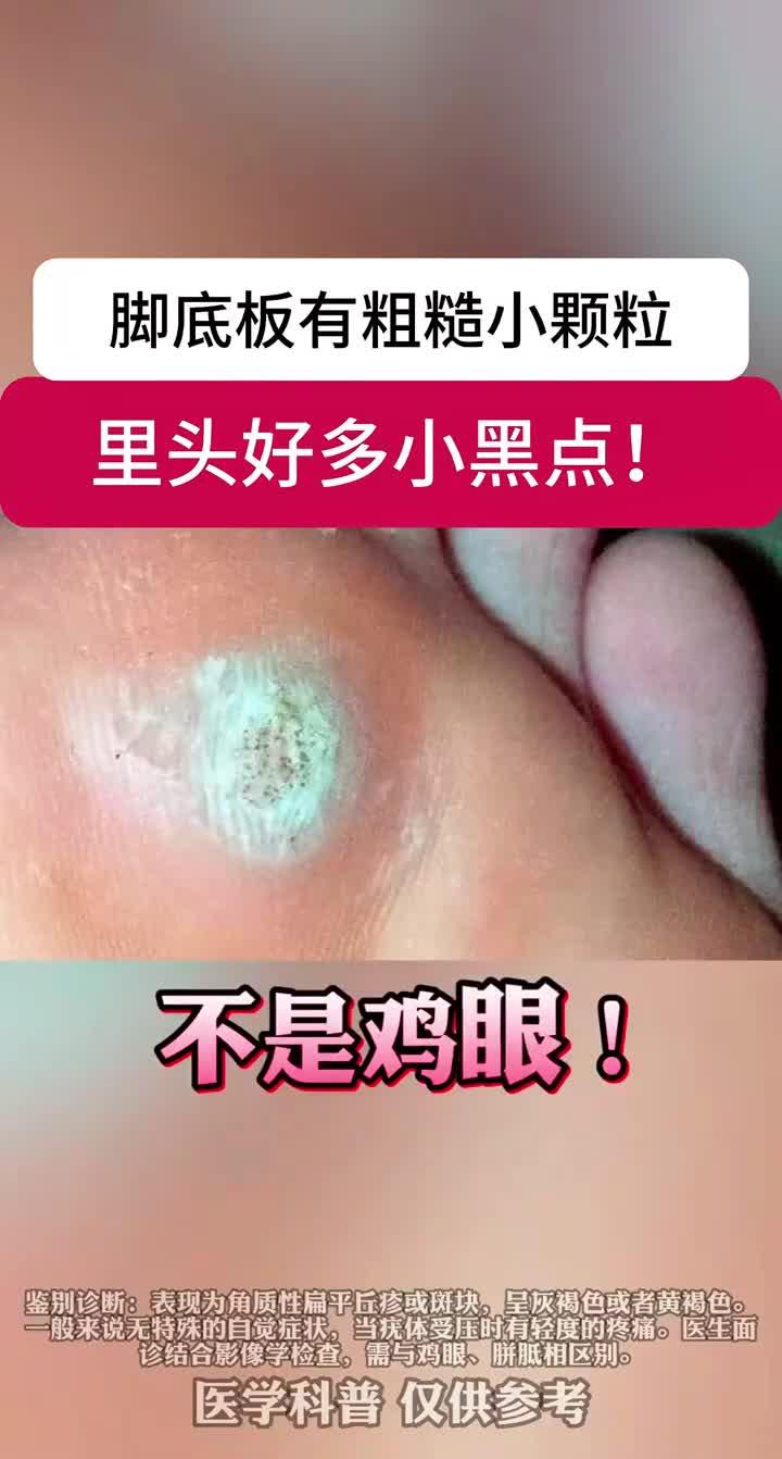 脚底板长小疙瘩,里面有很多小黑点,可别当鸡眼治!这是跖疣
