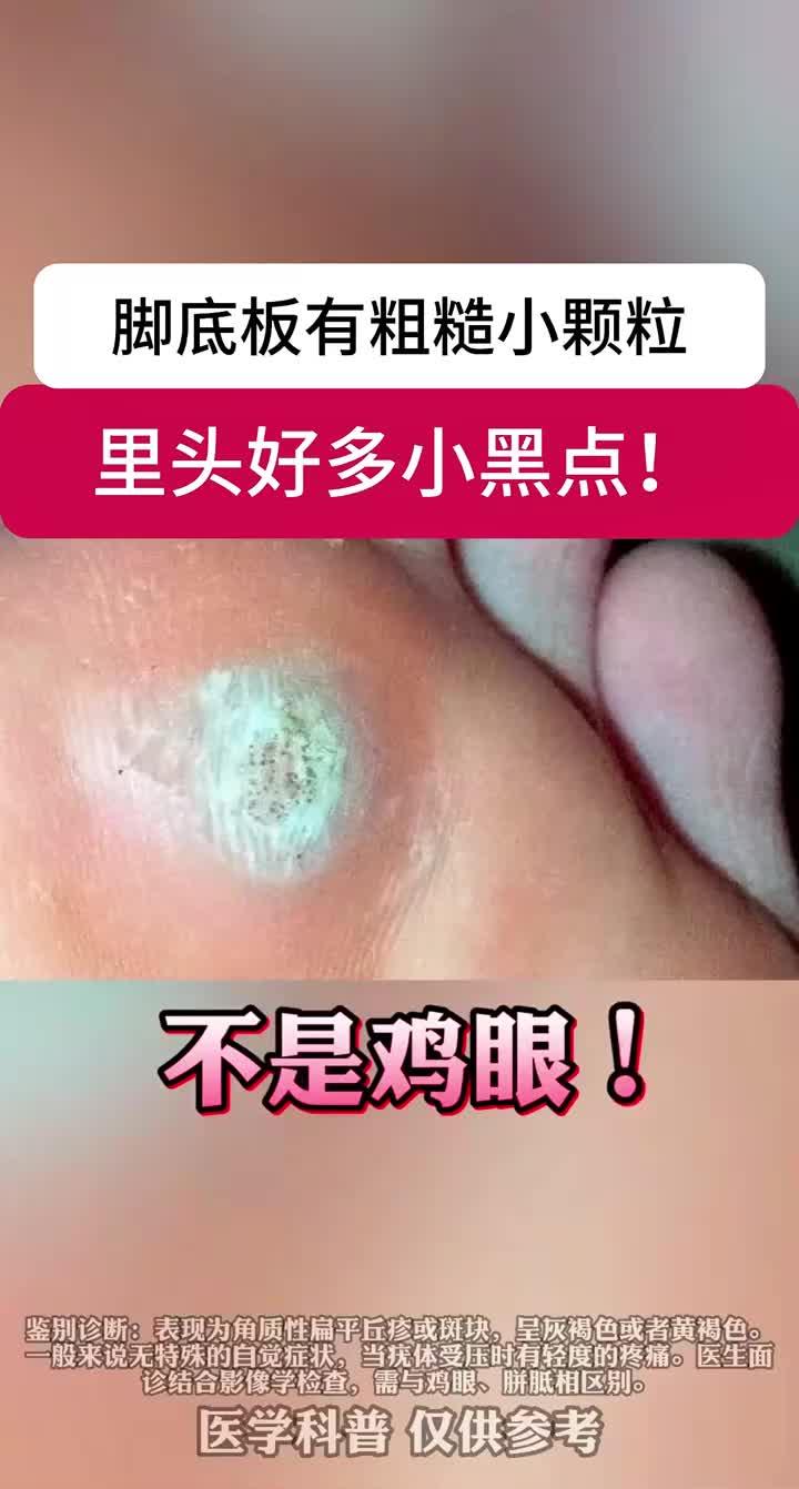脚底板长小疙瘩,里面有很多小黑点,可别当鸡眼治!这是跖疣