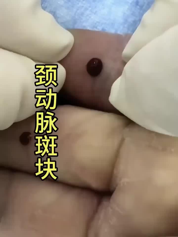 颈动脉斑块治疗:刺络放血疗法解析
