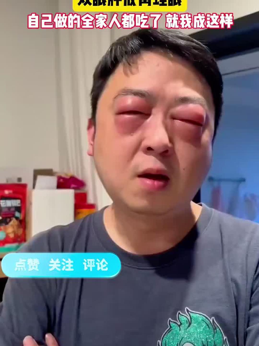 男子吃小龙虾过敏险毁容,双眼红肿如“青蛙眼”