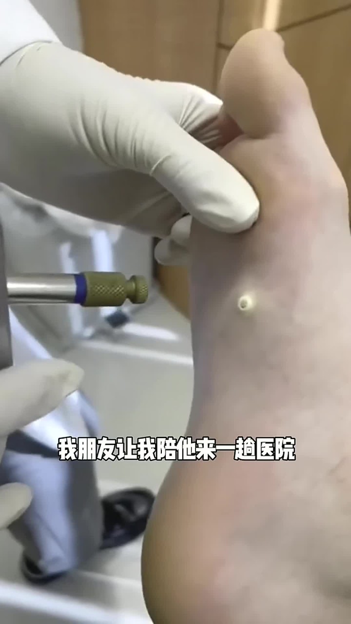 脚上长个大鸡眼